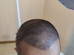 -碧莲盛·不剃发植发