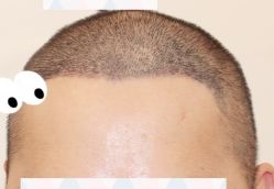 -大麦微针植发全国连锁