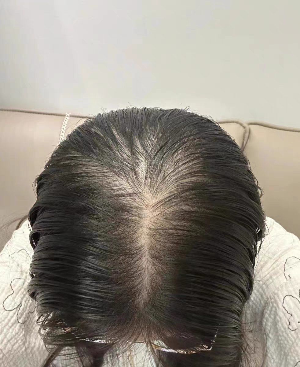 毛发稀疏,发际线高