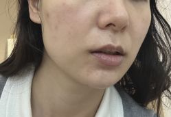 体验后-恒妍医美·韩国定制抗衰中心