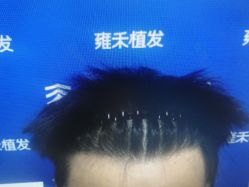 -雍禾植发全国连锁