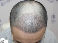 -大麦微针植发丨全国连锁