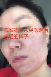 体验后-伊丽莎白医疗美容