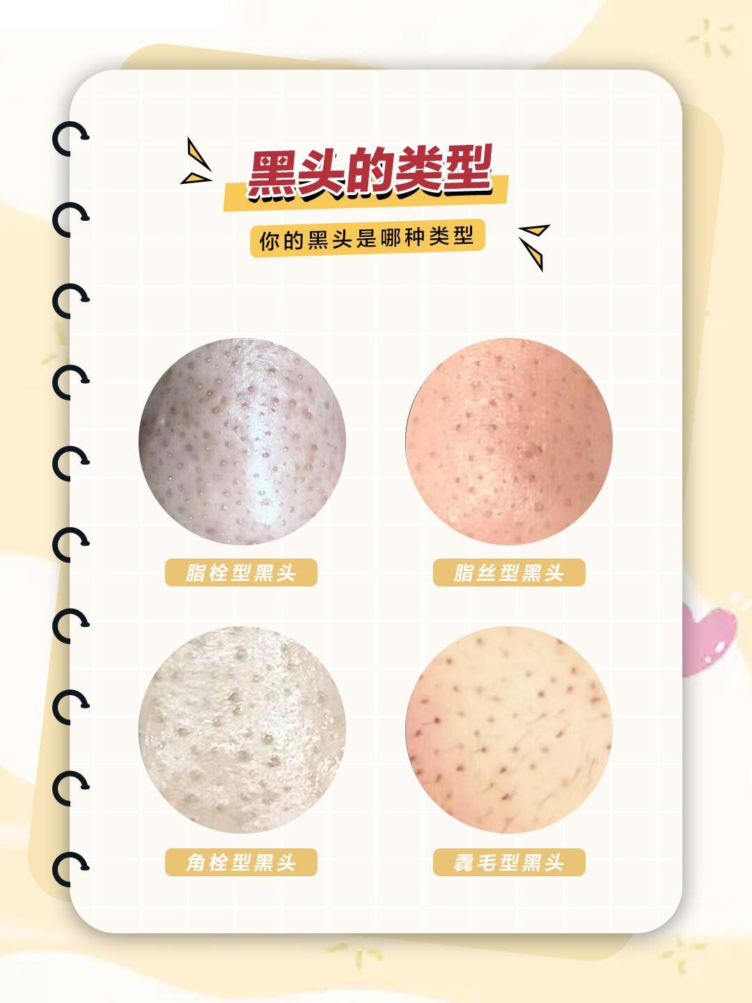 拯救草莓鼻,1分钟认清真假黑头