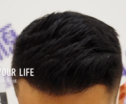 -大麦微针植发全国连锁