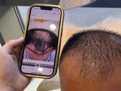 -碧莲盛·不剃发植发