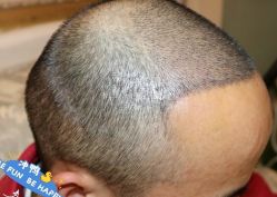 -大麦微针植发丨全国连锁