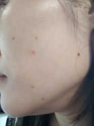 -痣缘宫