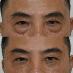 -广州健丽·去眼袋医疗美容机构