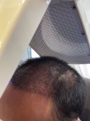 -碧莲盛·不剃发植发