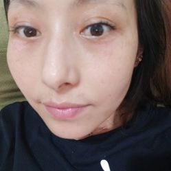 -爱莎扁平疣·汗管瘤·斑痣中心