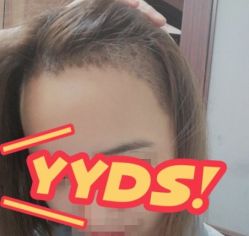 -大麦微针植发丨全国连锁