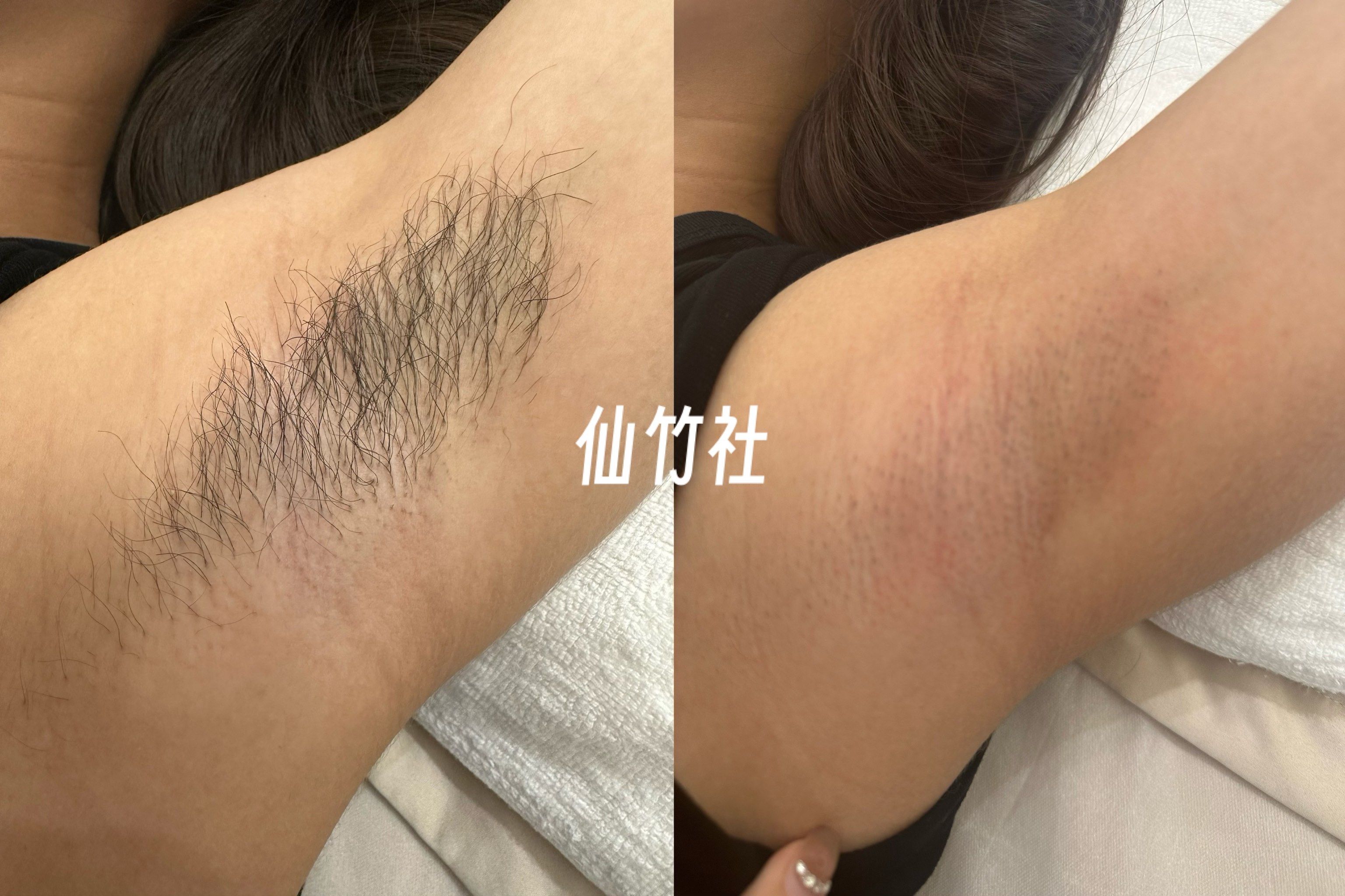 冰点脱毛