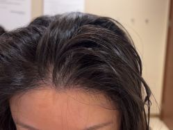 -碧莲盛·不剃发植发