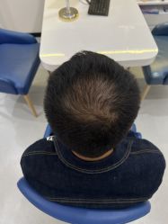 体验后-大麦微针植发全国连锁