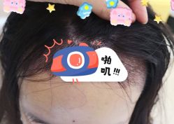 -大麦微针植发全国连锁