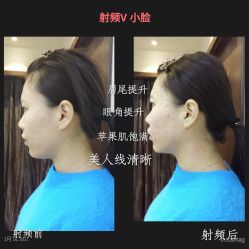 小v脸-光SPA科技美肤