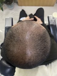 -大麦微针植发全国连锁