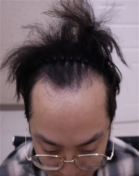 -大麦微针植发丨全国连锁