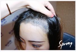 点击看大图 体验后-大麦微针植发全国连锁