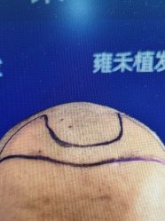 -雍禾植发全国连锁