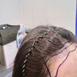 -碧莲盛·不剃发植发