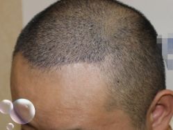 -大麦微针植发丨全国连锁