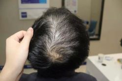 -大麦微针植发全国连锁