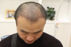 点击看大图 -大麦微针植发丨全国连锁