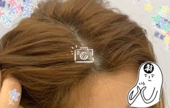 -大麦微针植发全国连锁