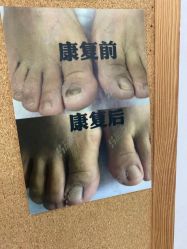 -EPAI·灰指甲·甲沟炎·嵌甲护理