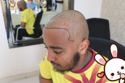 点击看大图 -大麦微针植发丨全国连锁