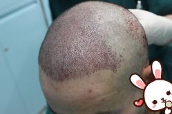 -大麦微针植发丨全国连锁