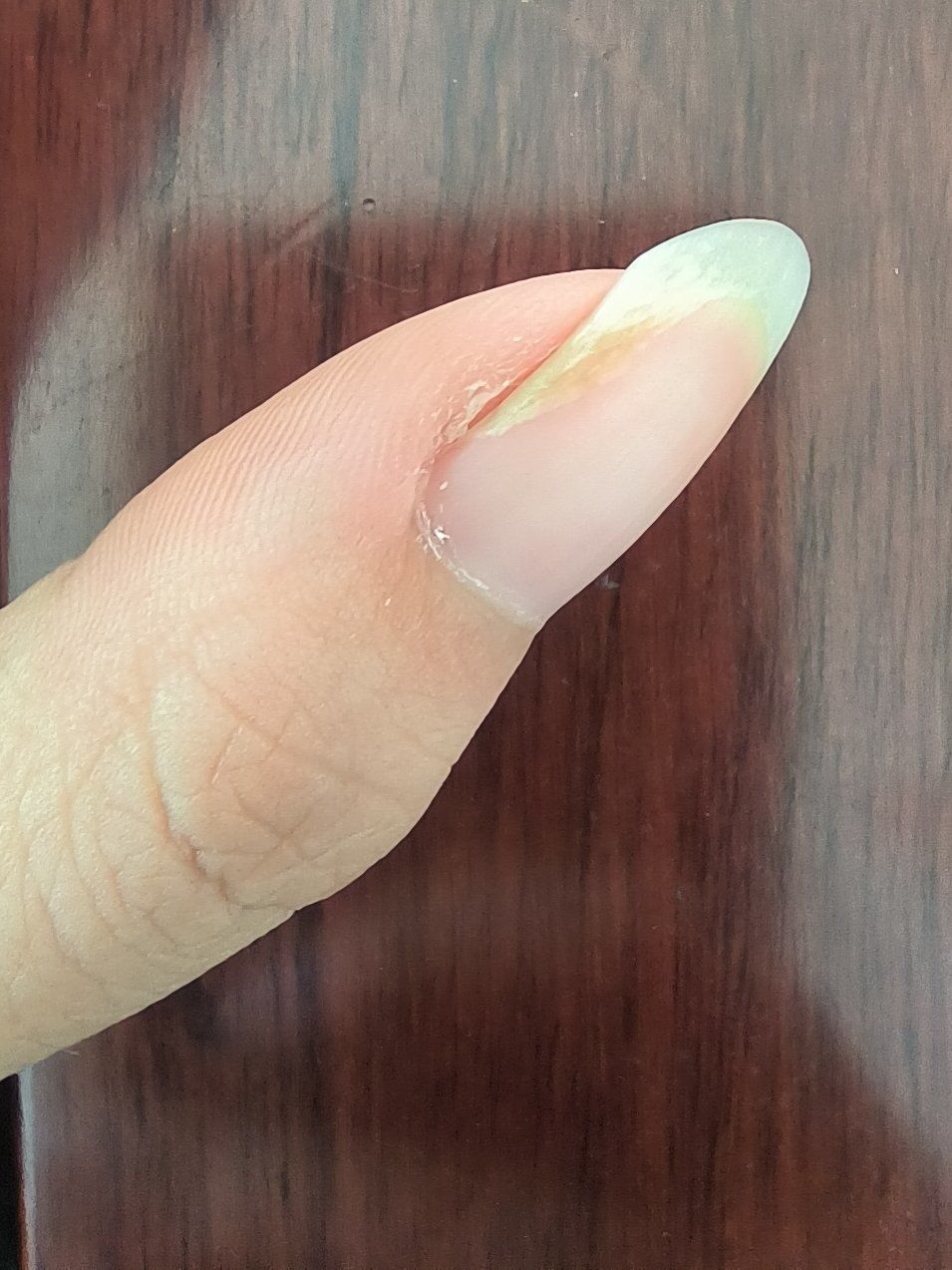 我想问问博学多才的网友们:我指甲和肉分离