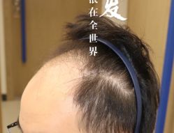 -大麦微针植发全国连锁