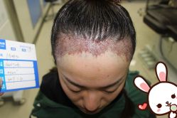 点击看大图 -大麦微针植发丨全国连锁