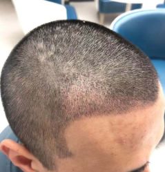 -大麦微针植发全国连锁