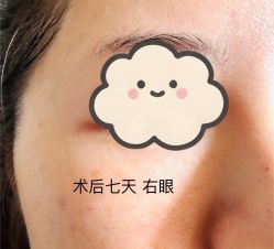 体验后-深圳鹏爱秀琪医疗美容医院