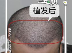 -大麦微针植发全国连锁