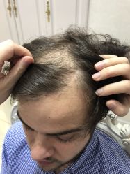 -大麦微针植发丨全国连锁