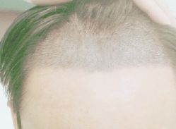 -大麦微针植发丨全国连锁