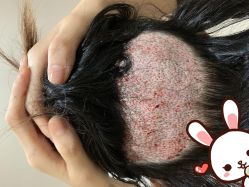 点击看大图 -大麦微针植发丨全国连锁