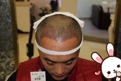 点击看大图 -大麦微针植发丨全国连锁