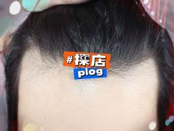 -大麦微针植发全国连锁