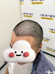 -大麦微针植发全国连锁