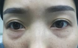 -天津健丽·去眼袋医疗美容机构