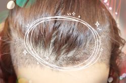 -大麦微针植发全国连锁