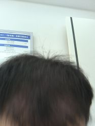 -大麦微针植发丨全国连锁