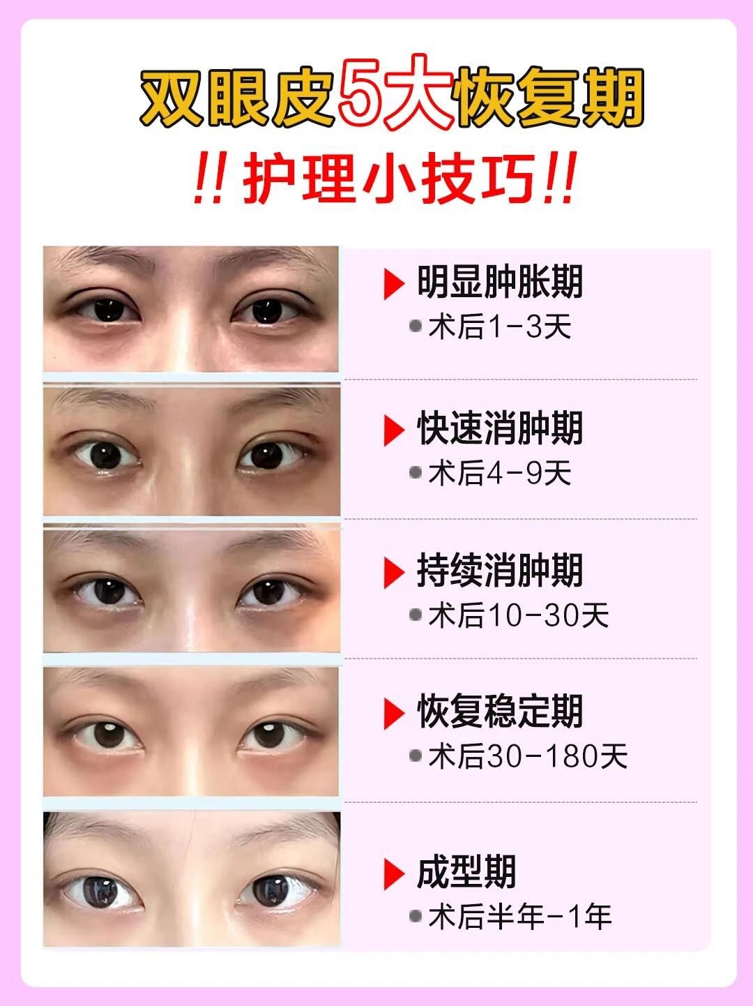 双眼皮5大恢复期