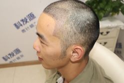 点击看大图 -大麦微针植发丨全国连锁